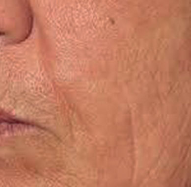 Onda Dinamica® Face & Body — Policzek, po