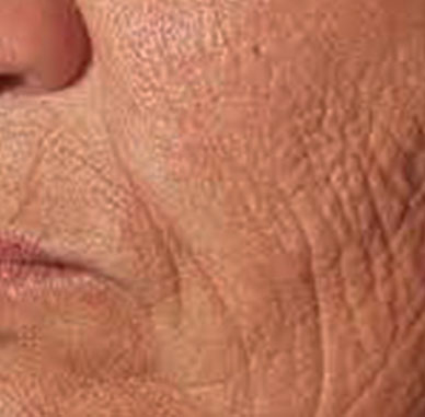 Onda Dinamica® Face & Body — Policzek, przed