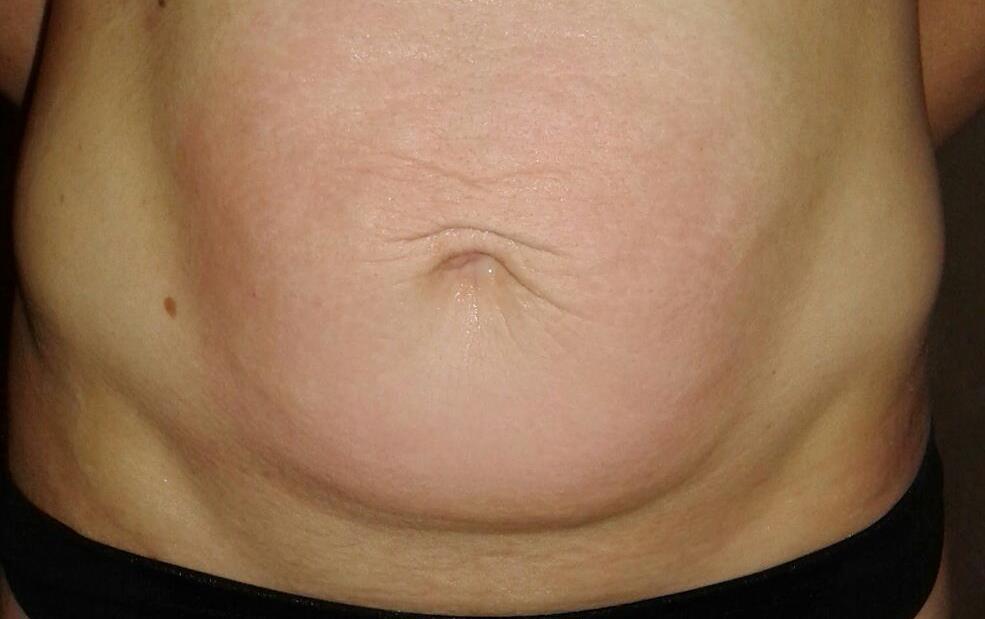 Onda Dinamica® Total Body — Brzuch, po