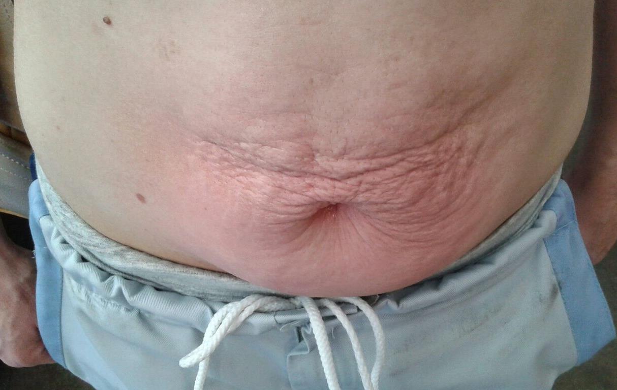 Onda Dinamica® Total Body — Brzuch, przed