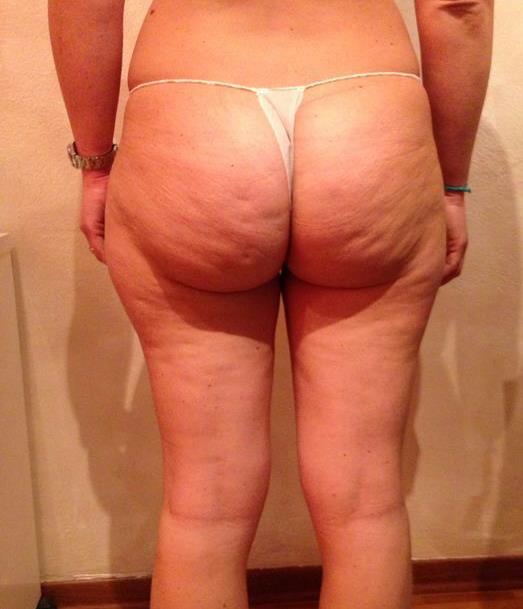 Onda Dinamica® Total Body — Uda i pośladki, przed