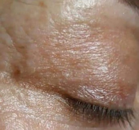 Onda Dinamica® Total Face — Okolica oka, po