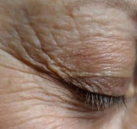 Onda Dinamica® Total Face — Okolica oka, przed