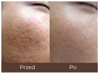 Tulium + Erbium 30 W — Przed i po — przykład 2; porównanie przed i po