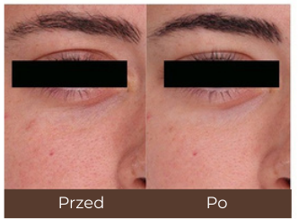Tulium + Erbium 30 W — Przed i po — przykład 3; porównanie przed i po