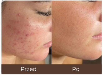 Tulium + Erbium 30 W — Przed i po — przykład 5; porównanie przed i po