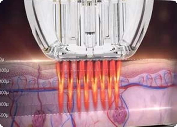 Pinxel-mechanizm-działania